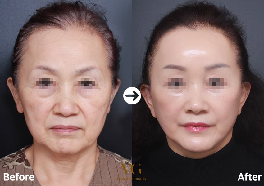 拉皮手術
