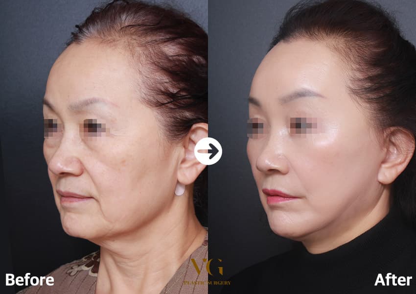 Three-quarter view before and after a mini facelift: the sagging cheek and deep fold beside the mouth are lifted, and the jaw edge is smoother