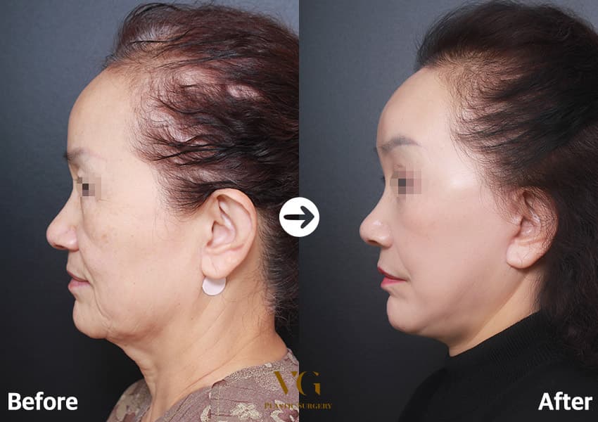 Side view before and after a facelift: loose skin along the jaw and under the chin before, a tighter jaw line after