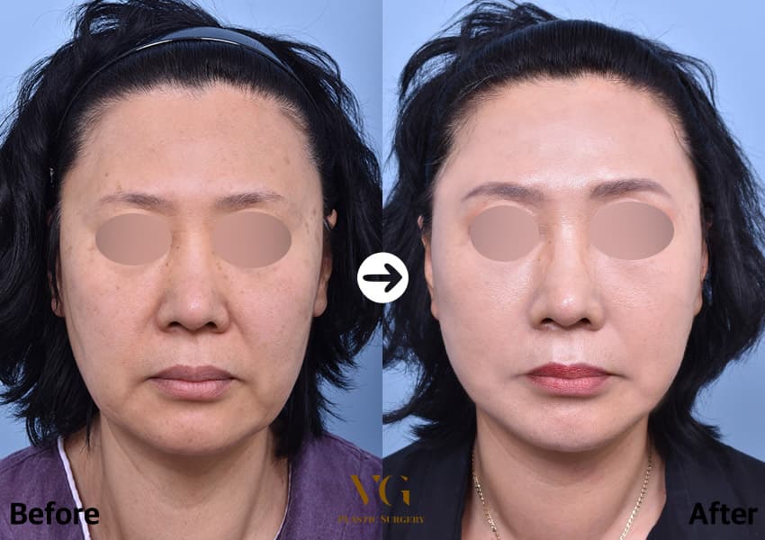 Front view before and after a mini facelift: heavy lower cheeks and deep folds beside the mouth on the left, a lifted lower face on the right