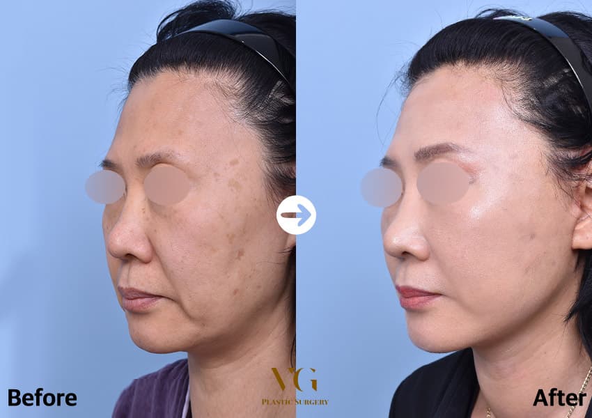 Three-quarter view before and after a mini facelift: loose lower cheek and jowl on the left, a smoother cheek-to-jaw line on the right