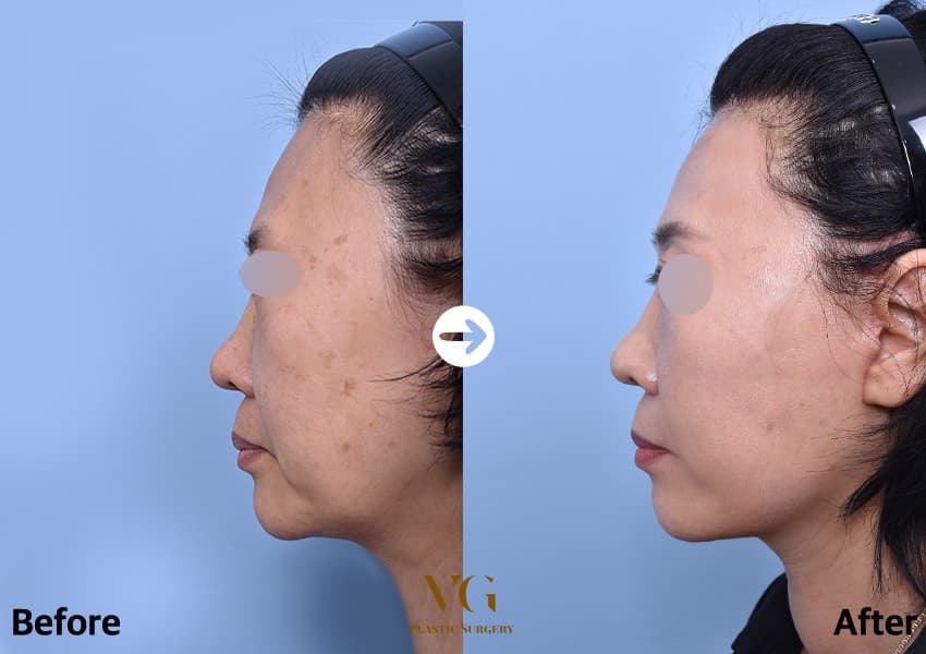 Side profile before and after a mini facelift, showing the lower cheek and the line along the jaw sitting higher after surgery