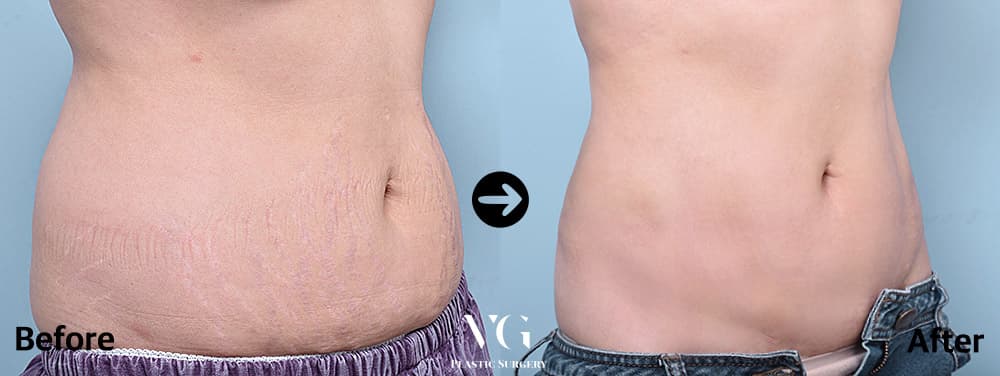 Abdominal Liposuction