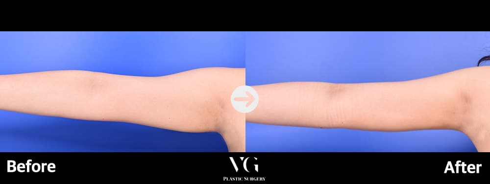 Arm Liposuction
