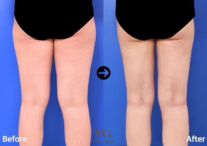 Thigh Liposuction