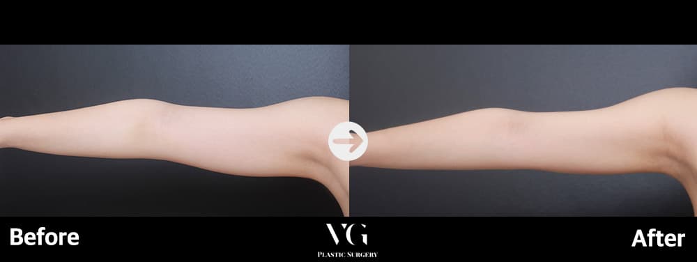 Arm Liposuction