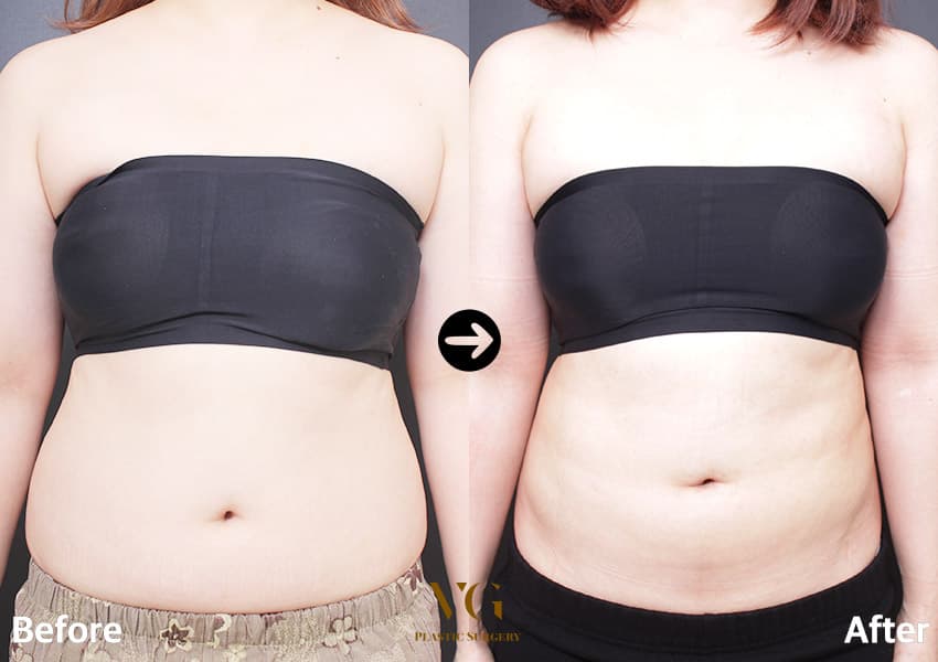 Abdominal Liposuction