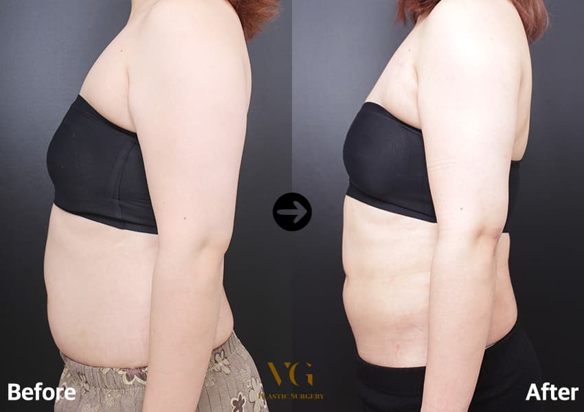 Side view before and after abdominal liposuction: a rounded lower belly on the left, a flatter abdominal profile on the right