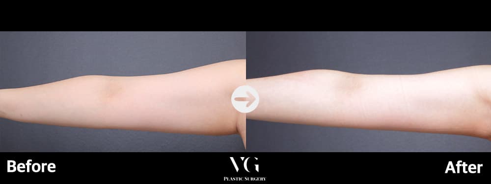 Arm Liposuction
