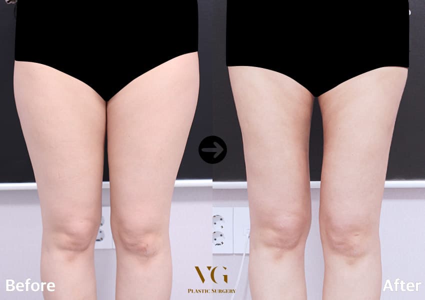 Thigh Liposuction