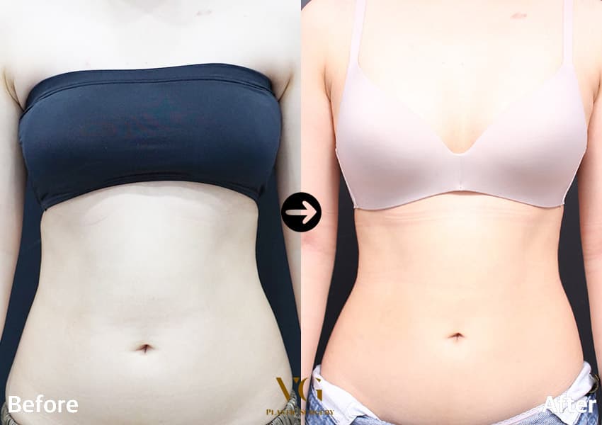 Before and after: Abdominal Liposuction
