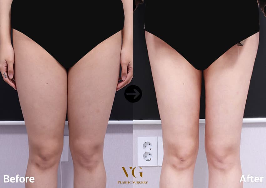 Thigh Liposuction
