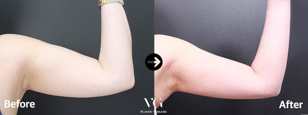 Before and after: Arm Liposuction