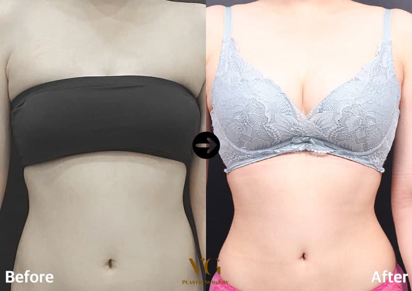 Abdominal Liposuction + Love-Handle Liposuction