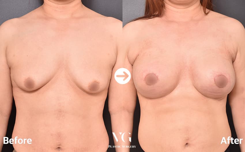 Breast Augmentation + Breast Lift