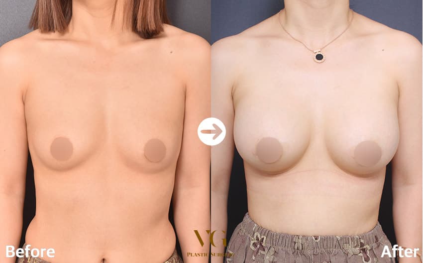Before and after: Breast Augmentation