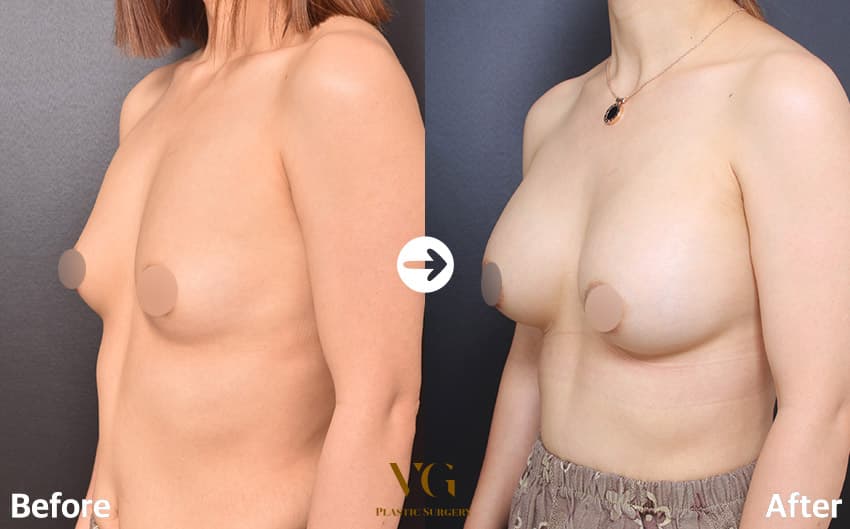 Three-quarter view of the same case: a flat side profile on the left, a fuller curve from the upper chest to the fold on the right
