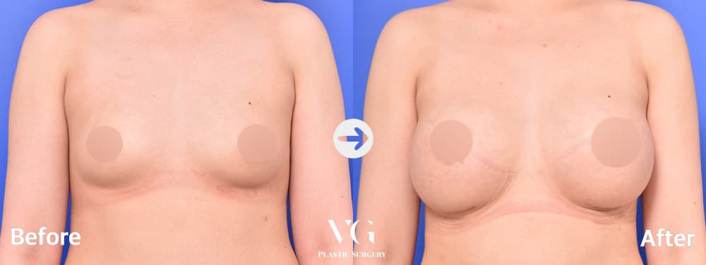 Breast Augmentation