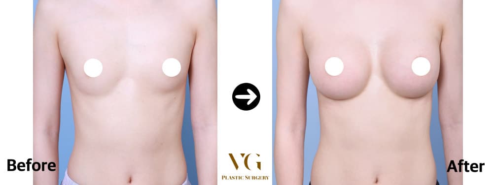 Breast Augmentation — View 1