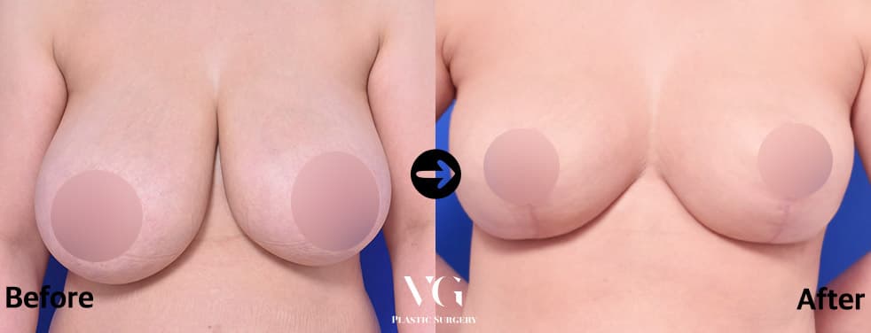 가슴축소술 — 각도 1