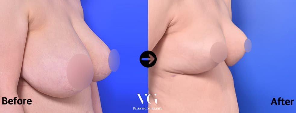 Three-quarter view of the same reduction case: a heavy breast hanging low over the ribs before, a smaller, higher breast after