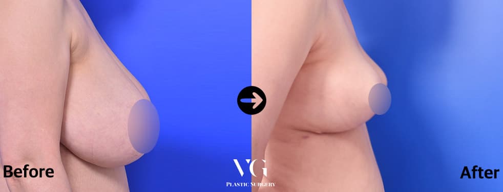 Side view before and after: the breast reaches far down the chest wall before and sits higher with a shorter profile after