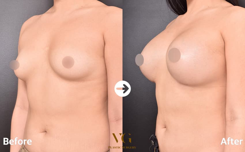 豊胸手術を斜めから見た術前術後。左は胸の張り出しが小さく、右は乳房の前方への厚みと下側の丸みがはっきりしている