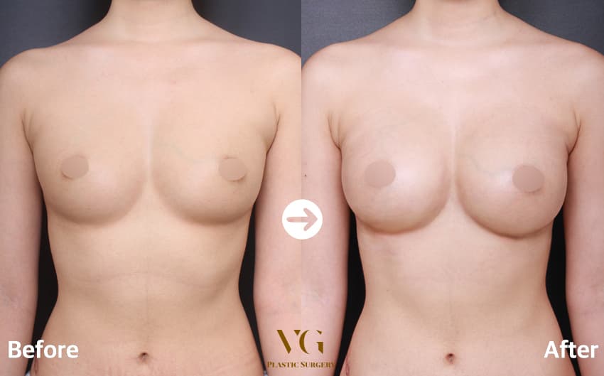 豊胸手術を受けた別の方の正面比較。左は乳房の上側がなだらかで左右にやや差がある状態、右は上側から下側までボリュームが加わっている