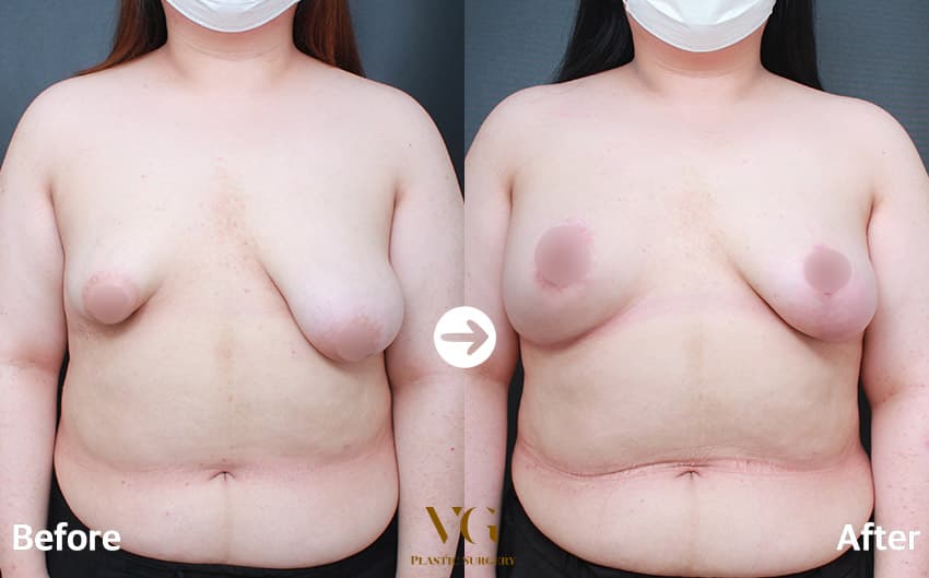 Front view before and after: one breast clearly larger and lower than the other before, the two sides much closer in size after