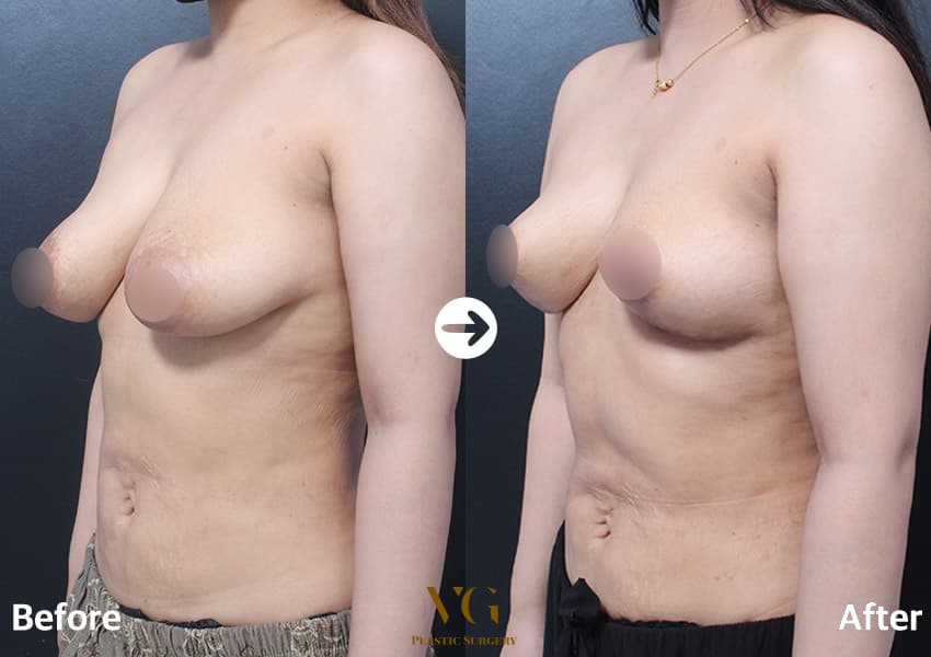 Three-quarter view of the same case: a breast sagging below the fold before, a lifted, more compact shape after