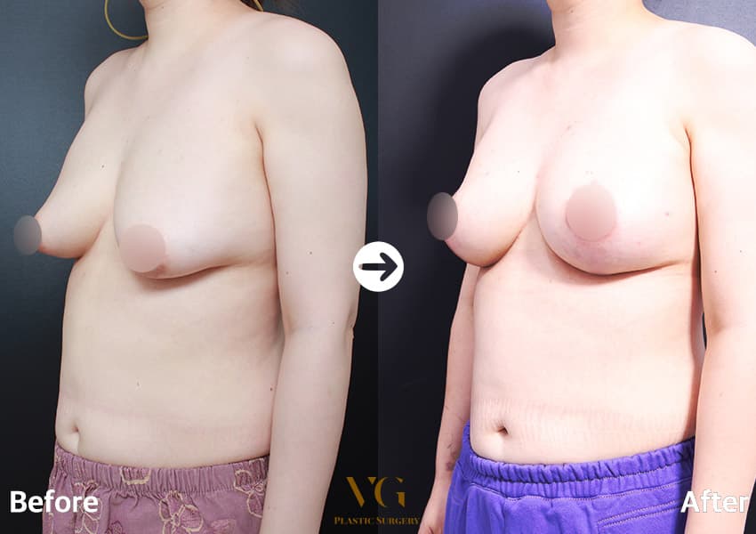 Angled view before and after a breast lift: a heavy breast with a low, downward-pointing nipple is raised to a rounder, higher shape