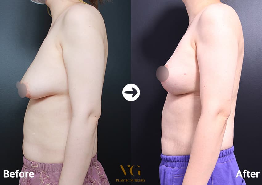 Side view of the same lift case: the nipple moves from below the breast fold to the front of the breast, with a firmer lower curve