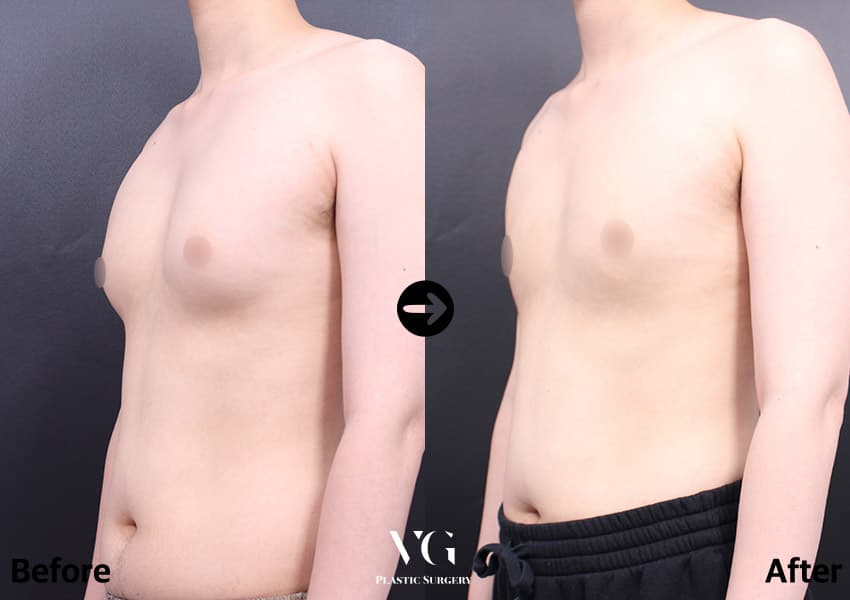 Three-quarter view of the same patient: breast tissue projecting forward from the chest before, a flatter side profile after