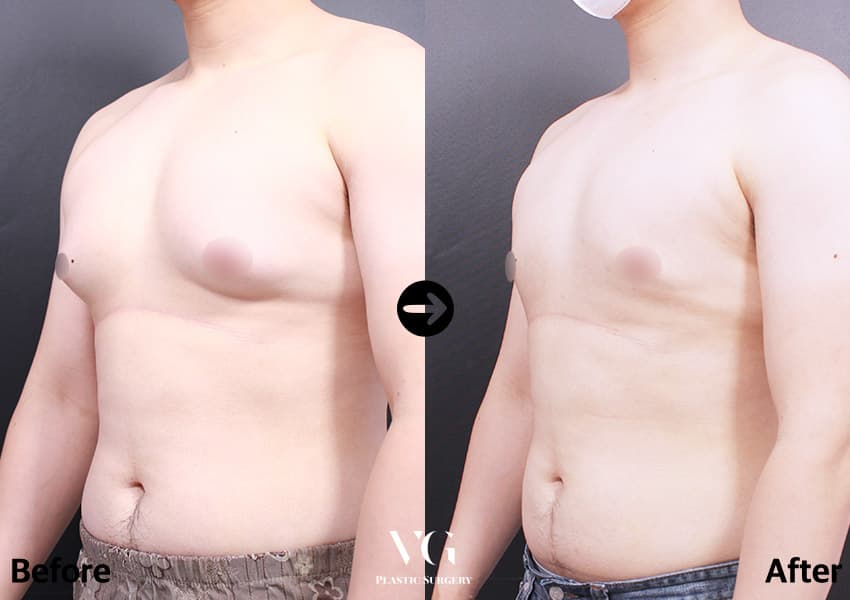 Three-quarter view of the same case: rounded breast tissue overhanging the lower chest before, a flatter contour after