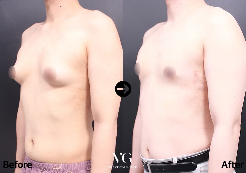 Three-quarter view of the same case: a cone-shaped breast before, a flat contour along the chest wall after
