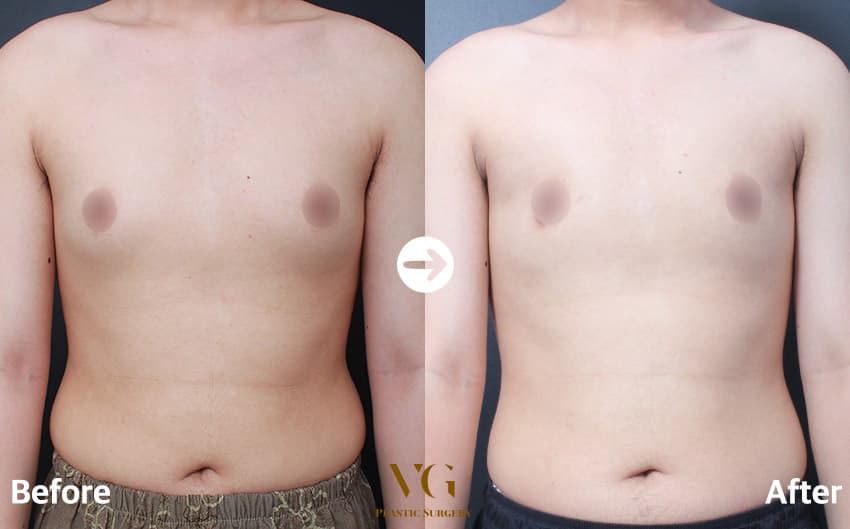 Front view before and after: mild puffiness around both nipples before, a smoother, flatter chest after