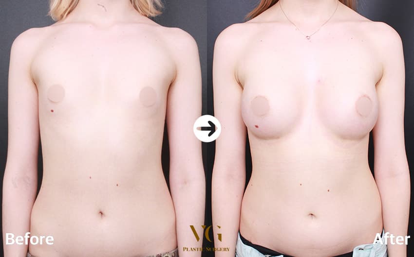Breast Augmentation — View 1