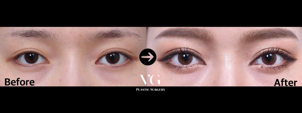 自然癒着二重 + 眼瞼下垂矯正の術前術後 — ドラッグして比較