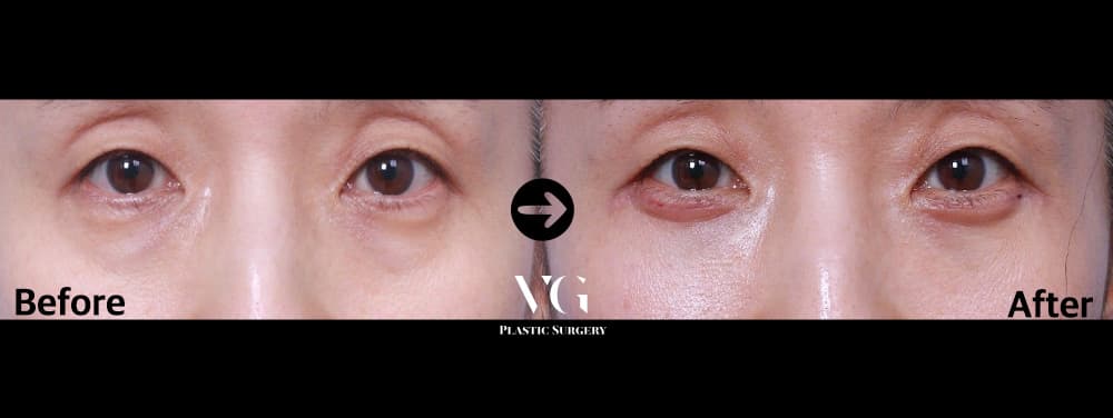 下眼瞼(たるみ・脂肪)の術前術後 — ドラッグして比較