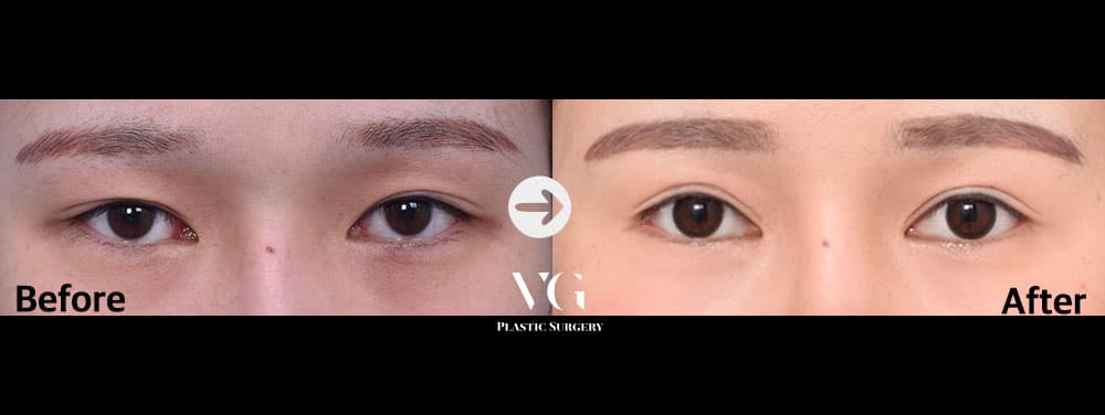 目の再手術 — 切開二重 + デュアル切開の術前術後 — ドラッグして比較