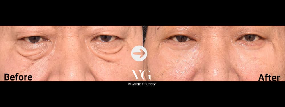 下眼瞼形成 — アングル1