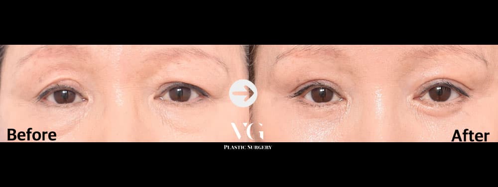 Upper Blepharoplasty