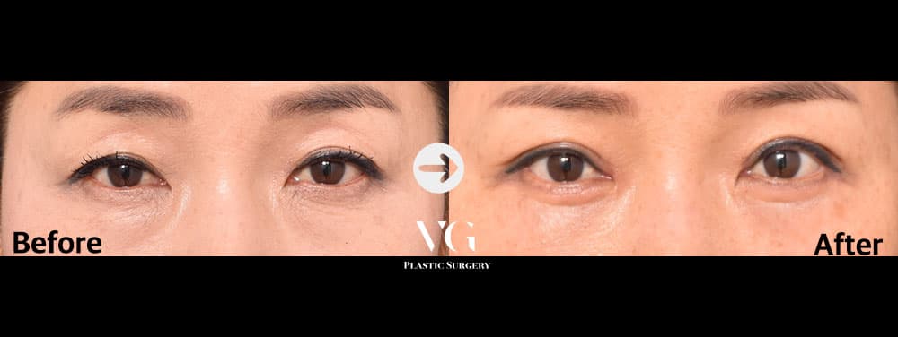 Upper Blepharoplasty
