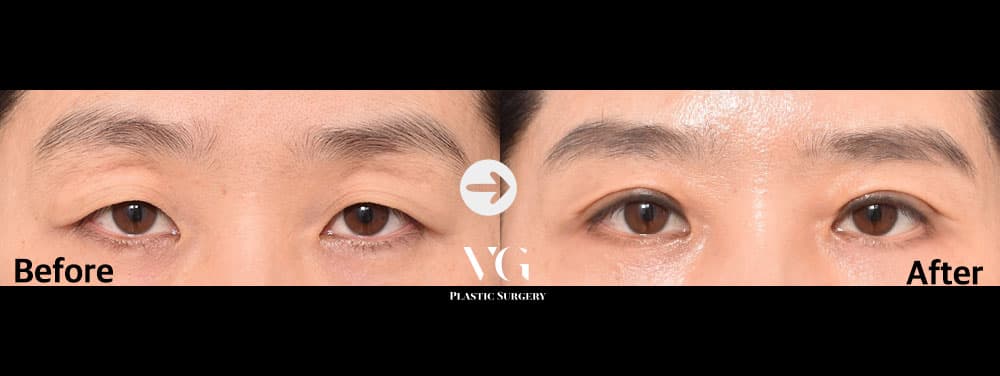 Upper Blepharoplasty — View 1