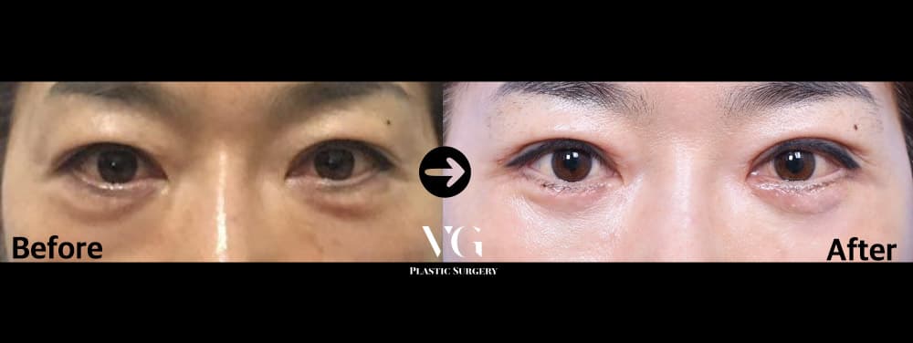 ผ่าตัดหนังตาล่าง — มุมที่ 1