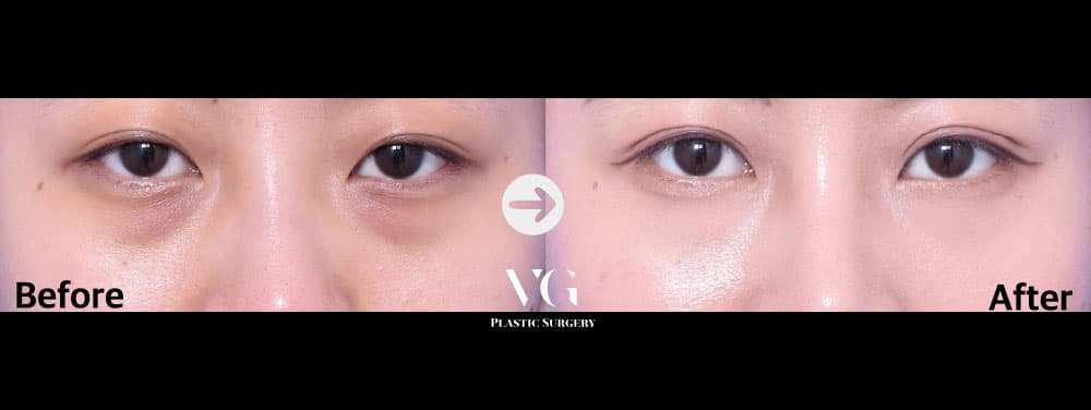 จัดเรียงไขมันใต้ตา