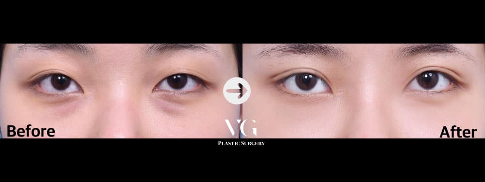 จัดเรียงไขมันใต้ตา
