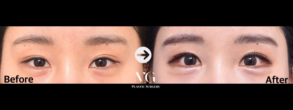 目の再手術 + 目尻切開 + 下眼瞼下制