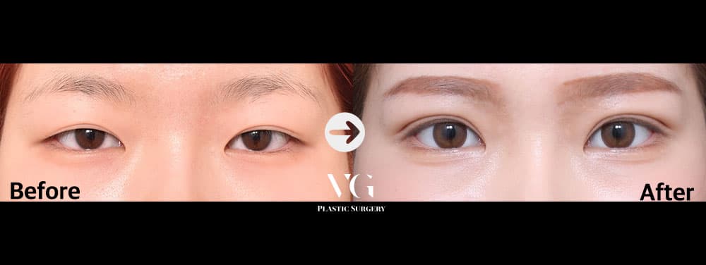 눈 재수술 + 절개 쌍꺼풀 + 절개 눈매교정