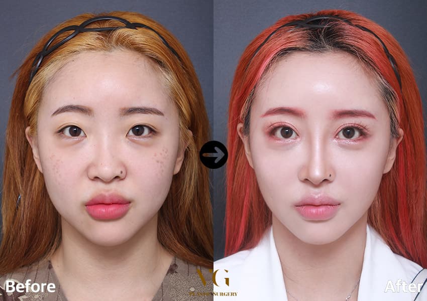 ตาสองชั้นแบบธรรมชาติ + แก้ไขกล้ามเนื้อตาแบบไม่กรีด + เปิดหัวตา +2